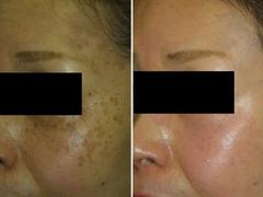 西安脫發(fā)價(jià)錢如何 專業(yè)可靠的西安脫發(fā)病治療