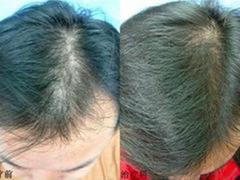 西安治療青春痘的醫(yī)院