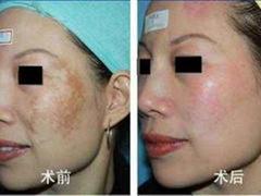 陜西{yl}的青春痘zl：青春痘怎么去除