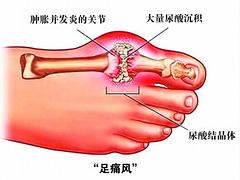 中醫(yī)zl高尿酸血癥 可靠的zl高尿酸推薦