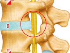 椎間盤突出zl動(dòng)態(tài) 哪里有服務(wù)周到的椎間盤突出zl