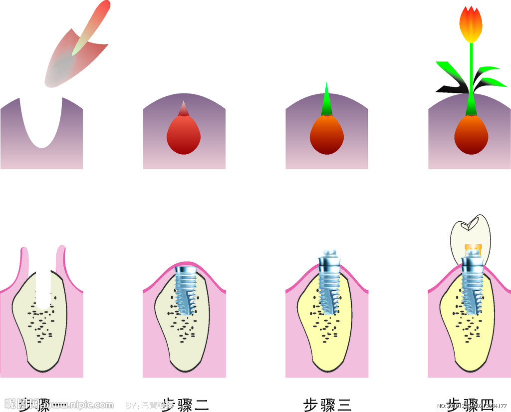 泉興口腔種植牙、泉州泉興口腔醫(yī)院、泉州種植牙找泉興