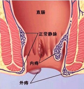 痔疮能根治吗？治痔疮用尚草痔舒茶无副作用