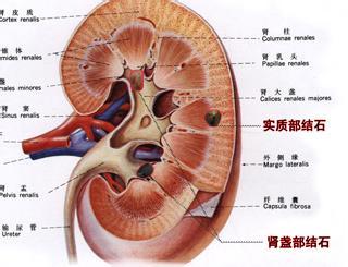 {gx}的腎結(jié)石中醫(yī)zl推薦：山東腎結(jié)石zl