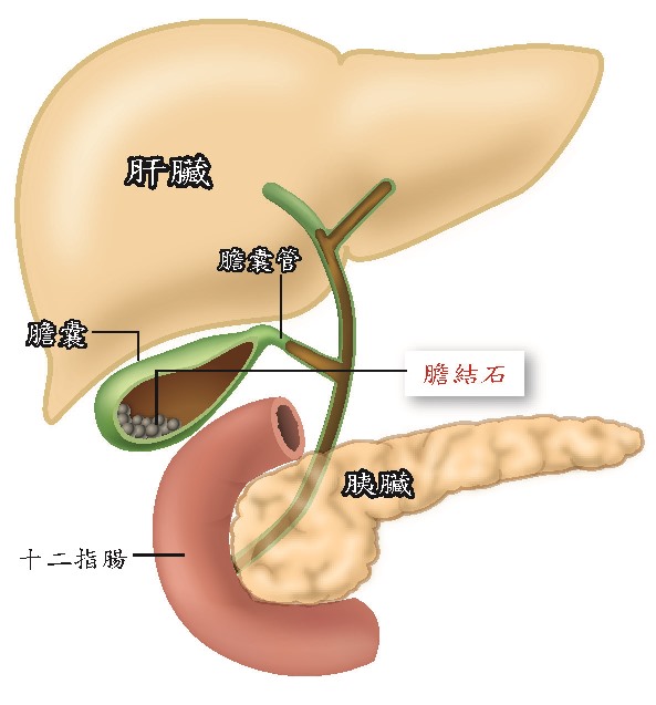 怎么zl膽結石，山東qw的膽結石zl推薦