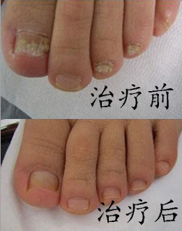 泰安專(zhuān)治npx/臨沂藍(lán)灣醫(yī)院