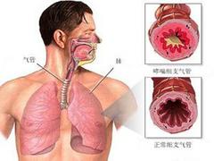 哪里有{gx}的矽肺病癥zl，矽肺zl咨詢
