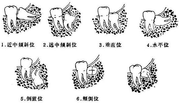 青島李村種植牙 李滄區(qū)種植牙哪里做好李村種植牙中心 雅安口腔