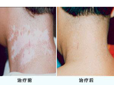 冬天zl白癜風(fēng)和夏天zl白癜風(fēng)有哪些區(qū)別？鄭州白癜風(fēng)醫(yī)院